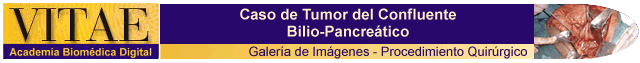 Cintillo Procedimiento quirrgico